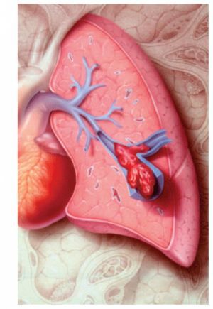 Эмболия легочной артерии: симптомы, лечение