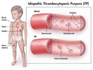 Идиопатическая тромбоцитопеническая пурпура: что это такое, лечение, диагностика, причины, симптомы, признаки
