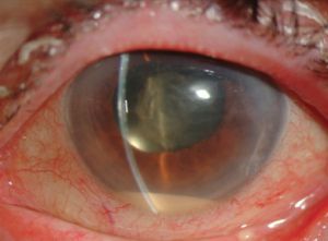 Послеоперационный эндофтальмит глаза