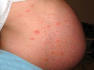 Кожная сыпь при вирусных инфекциях и беременность: лечение, причины, симптомы, признаки