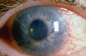 Первичная открытоугольная глаукома: лечение, симптомы, прогноз, причины