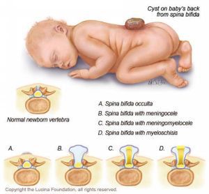 Дефекты нервной трубки у детей: энцефалоцеле, менингомиелоцеле