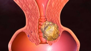 Вирус папилломы человека (ВПЧ) и рак шейки матки