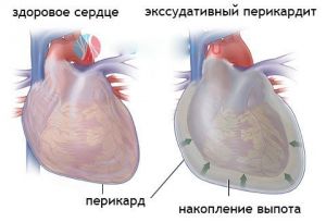 Экссудативный перикардит: что это такое, лечение, признаки, причины, симптомы Экссудативный перикардит: что это такое, лечение, признаки, причины, симптомы