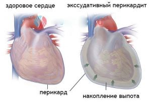 Экссудативный перикардит: что это такое, лечение, признаки, причины, симптомы