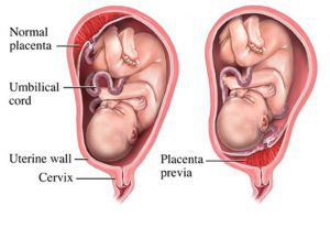 Задержка в матке плаценты и ее частей