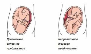 Неправильное положение ребенка Неправильное положение ребенка