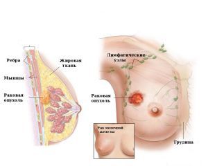 Злокачественные опухоли грудного протока