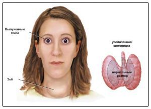 базедова болезнь, лечение, симптомы, причины (болезнь грейвса)
