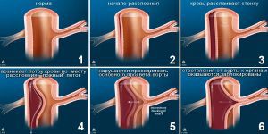 Аневризмы грудной аорты (грудного отдела): симптомы, лечение, диагностика, причины, признаки