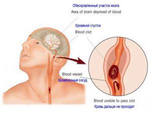 Ишемический инсульт головного мозга, лечение, симптомы, причины, признаки