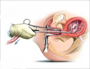 Хирургический аборт: последствия, как делают