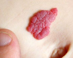 Синдром атипичного родимого пятна (Atypical mole syndrom)