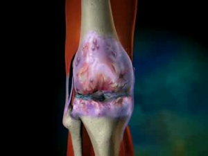 Деформирующий остеоартроз суставов: это такое, степени, лечение, признаки, причины, симптомы