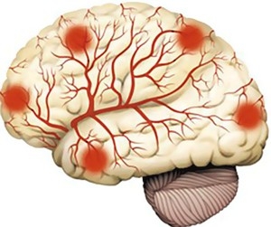 Дисциркуляторная атеросклеротическая энцефалопатия: что это такое, лечение, причины, симптомы, признаки