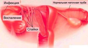 Трубное бесплодие: причины, лечение Трубное бесплодие: причины, лечение