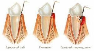 Гингивит: лечение, симптомы, признаки, причины
