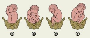 Тазовое предлежание плода при беременности: ведение родов, причины, признаки