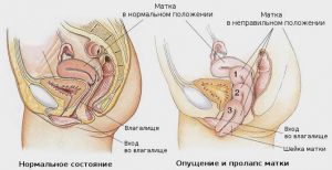 Пролапс матки и влагалища: лечение, симптомы, операция