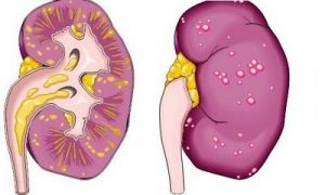Паранефральный абсцесс почки: симптомы, что это такое, диагностика, последствия