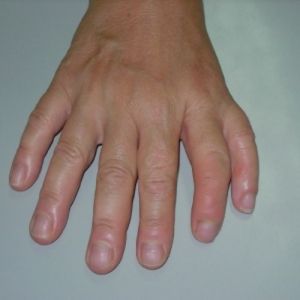 Удвоение первого пальца (лучевая или преаксиальная полидактилия)
