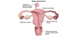 Лейомиома тела матки: что это такое, лечение, причины, симптомы, признаки, прогноз