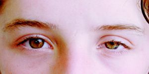 Глазной ишемический синдром: симптомы, лечение, классификация, причины