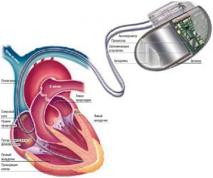 Электрокардиостимулятор имплантируемый