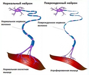 Поражения двигательных единиц и мышц