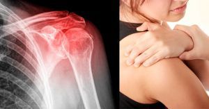 Травмы ротаторной манжеты плеча: лечение, симптомы, диагностика