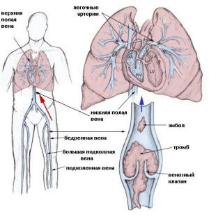 Эмболия и тромбоз артерий, лечение