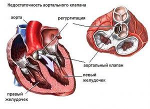 Аортальный порок сердца: лечение, симптомы, признаки, причины