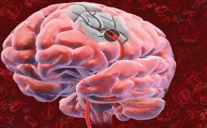 Опухоли головного мозга и его оболочек, приводящие к поражению зрительного пути