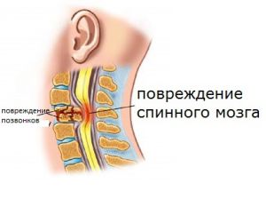 Травма спинного мозга: лечение, последствия, симптомы, признаки, причины