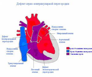 Дефект межжелудочковой перегородки сердца: что это такое, причины, лечение, симптомы, признаки
