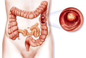 Полипы и полипозы в кишечнике: что это такое, симптомы, лечение, признаки, причины