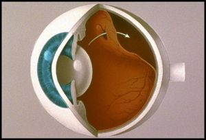 Отслойка сетчатки глаза: причины, симптомы, лечение, признаки