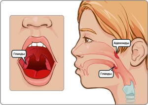Аденоиды: что это такое, лечение, симптомы, признаки, причины