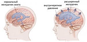 Повышенное внутричерепное давление: симптомы, лечение, признаки, причины Повышенное внутричерепное давление: симптомы, лечение, признаки, причины