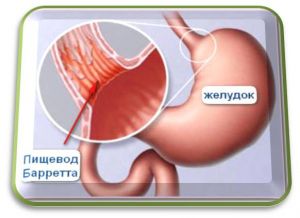 Пищевод Баррета: что это такое, симптомы, лечение, прогноз, причины, признаки