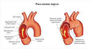 Расслоение аорты: что это такое, симптомы, причины, лечение, признаки, диагностика