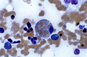 Гемофагоцитарный лимфогистиоцитоз: лечение, причины, прогноз