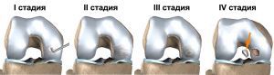 Рассекающий остеохондроз Кенига Рассекающий остеохондроз Кенига