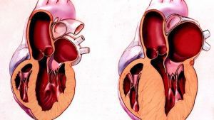 Гипертрофическая кардиомиопатия: что это такое, лечение, симптомы, признаки, причины