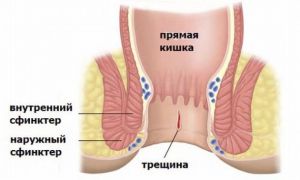 Кровотечение из прямой кишки: причины, лечение, симптомы, признаки