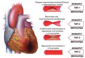 Желудочковые тахиаритмии: лечение, признаки, диагностика, причины, симптомы Желудочковые тахиаритмии: лечение, признаки, диагностика, причины, симптомы