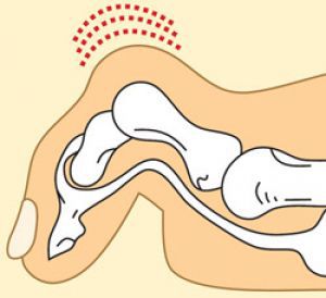 Врожденный молоткообразный большой палец: лечение, причины