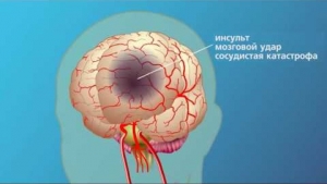 Церебральный инсульт: что это такое, лечение, причины, симптомы, признаки