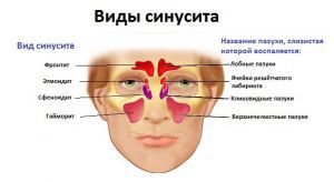 Хронический синусит: лечение, симптомы, признаки, причины, осложнения, профилактика