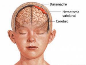 Субдуральная гематома головного мозга: лечение, последствия, симптомы, признаки, причины